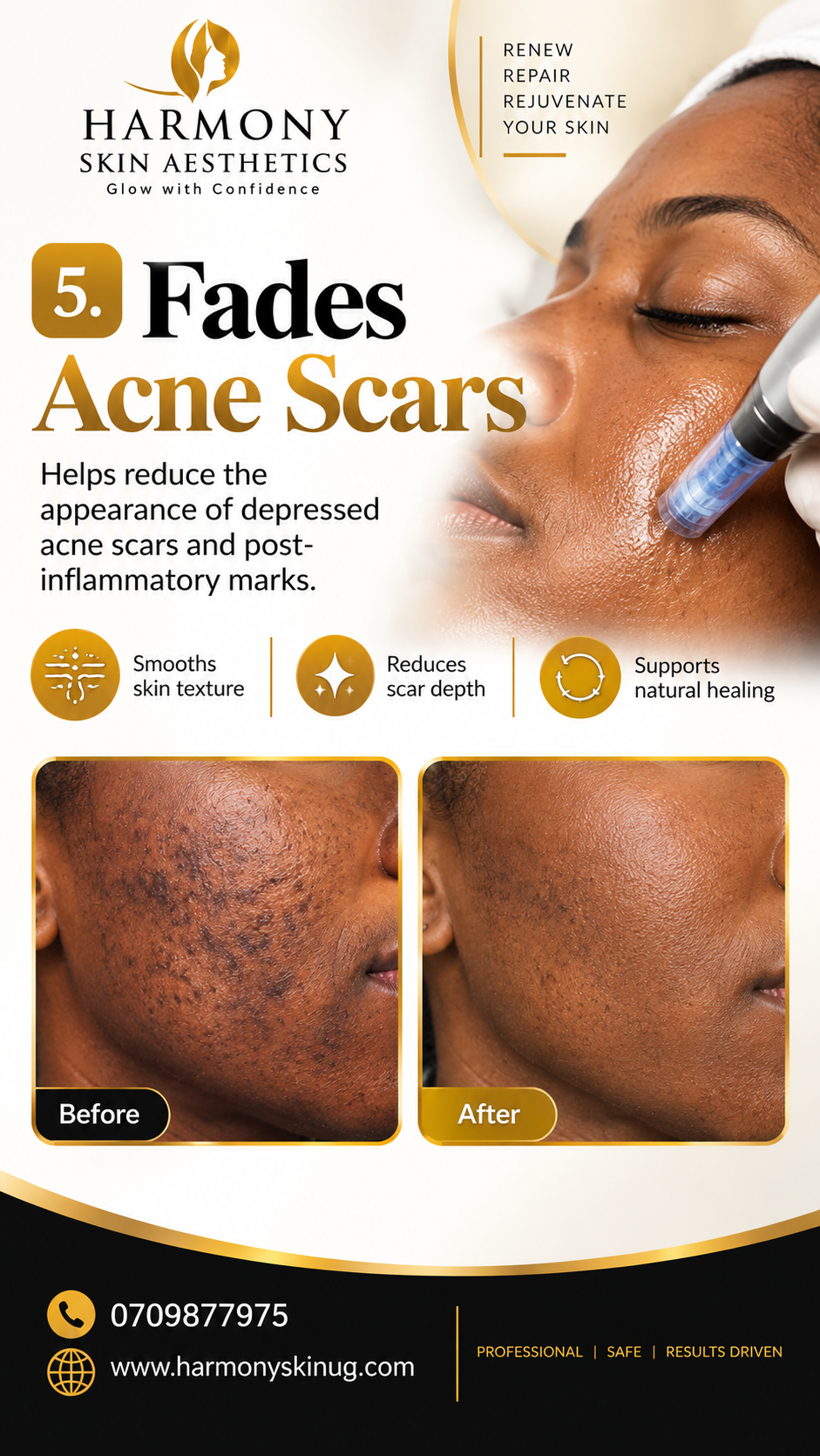 Acen scars?